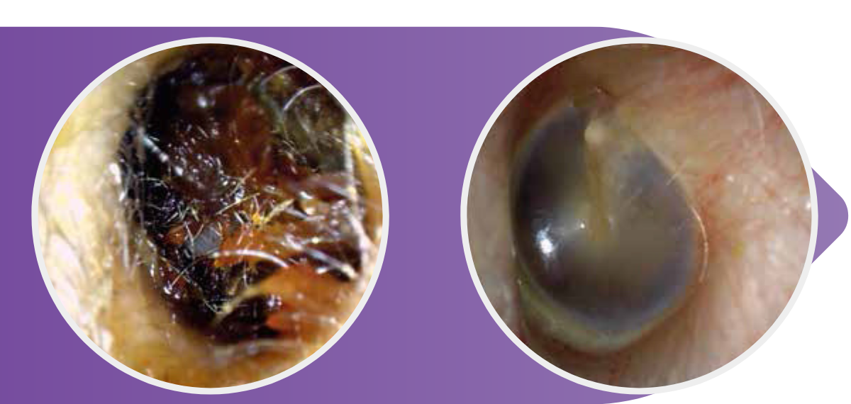 Before and after endoscopic ear wax removal showing blocked ear canal and clear eardrum