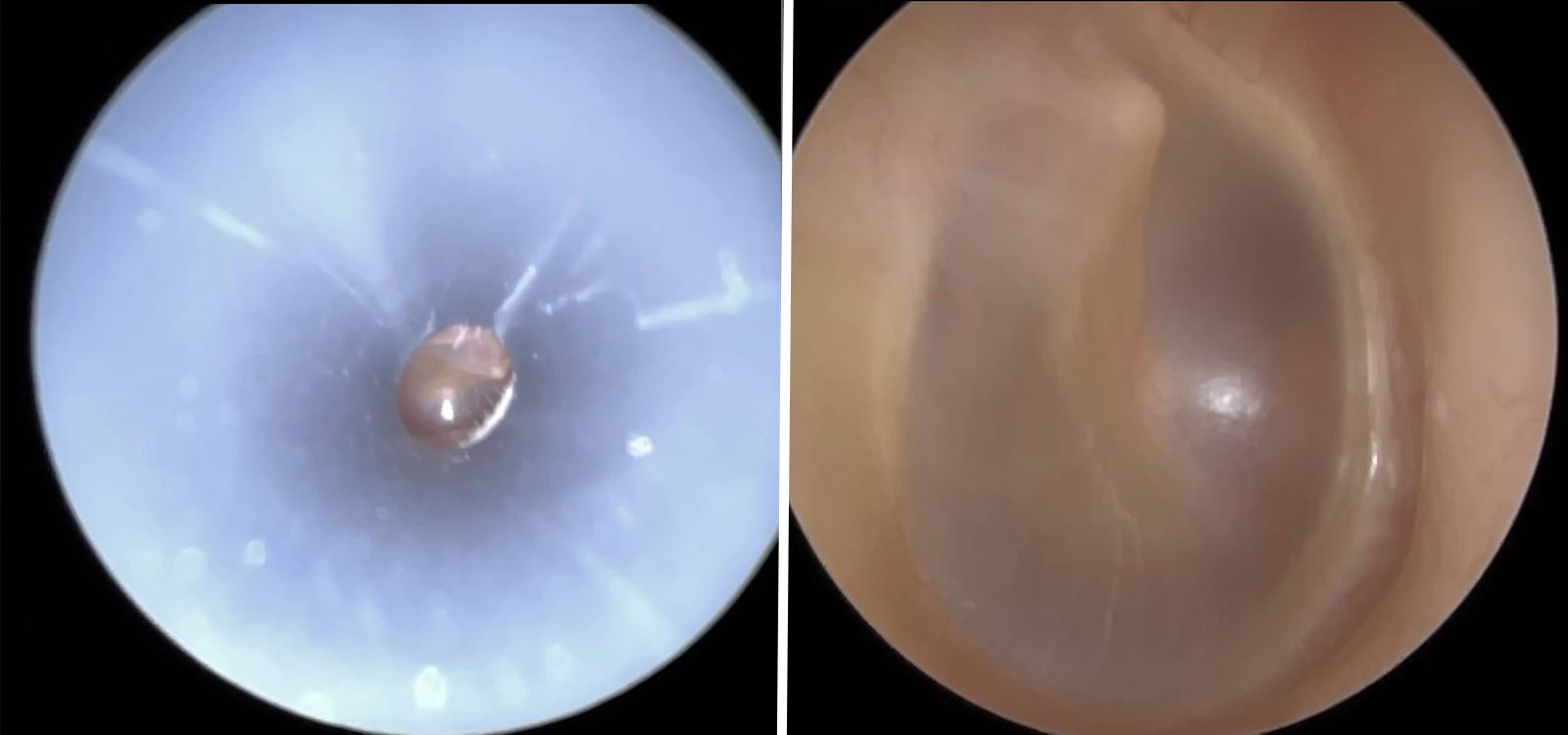 Comparison of head loupes versus high-definition endoscopic ear wax removal showing superior visualisation of the ear canal at The Hear Clinic Leicester